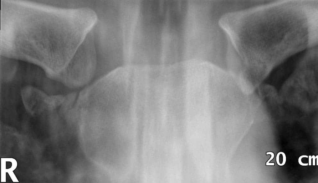 Fig 1.2 - Radiograph of an sternoclavicular joint dislocation.